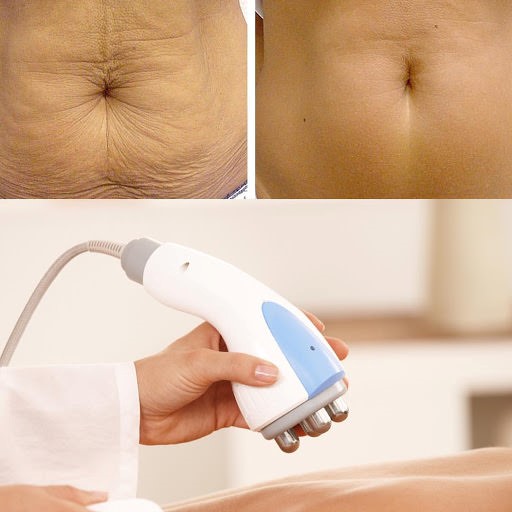 دستگاه های لاغری موضعی